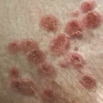 Varíola dos macacos