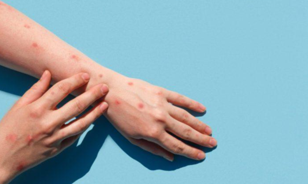 varíola dos macacos