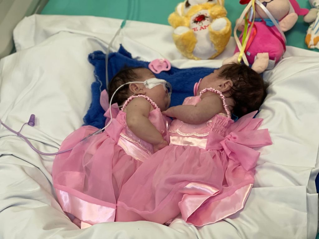 Gêmeas Yasmin e Eliza em recuperação após cirurgia de separação em Goiânia