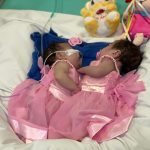 Gêmeas Yasmin e Eliza em recuperação após cirurgia de separação em Goiânia