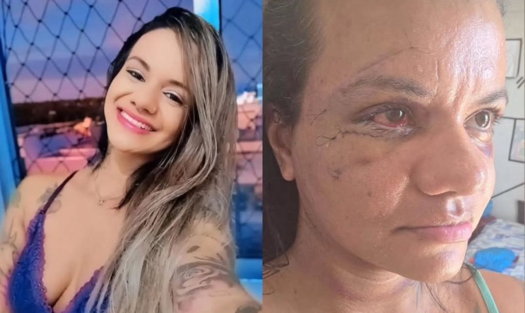 Juliana Soares mostra o rosto após cirurgia de reconstrução facial em Natal