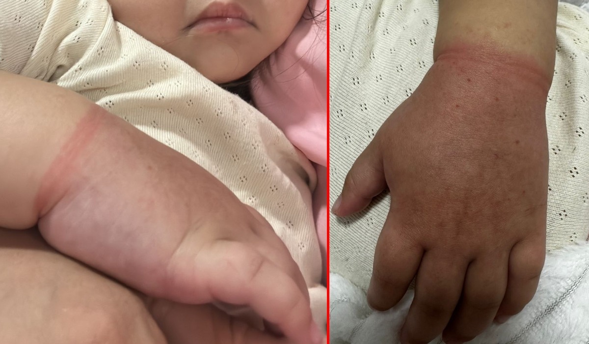 Menina de 2 anos quase perde a mão por causa de elástico de cabelo em Manaus