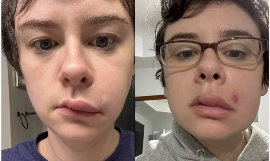 Espremer espinha leva mulher à internação por infecção facial