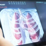 Paciente sobrevive 48 horas sem pulmões após cirurgia inédita