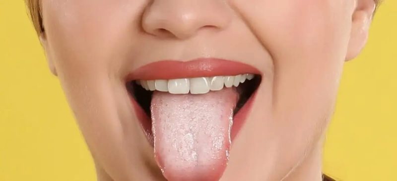 Você está com a língua branca? Do BBB ao Carnaval, Hapvida alerta sobre sinais da saúde bucal