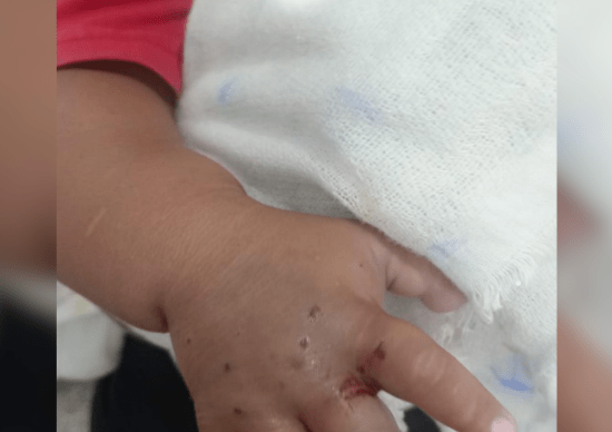 Bebê de 1 ano é transferido para Manaus após ser picado por cobra em Maués