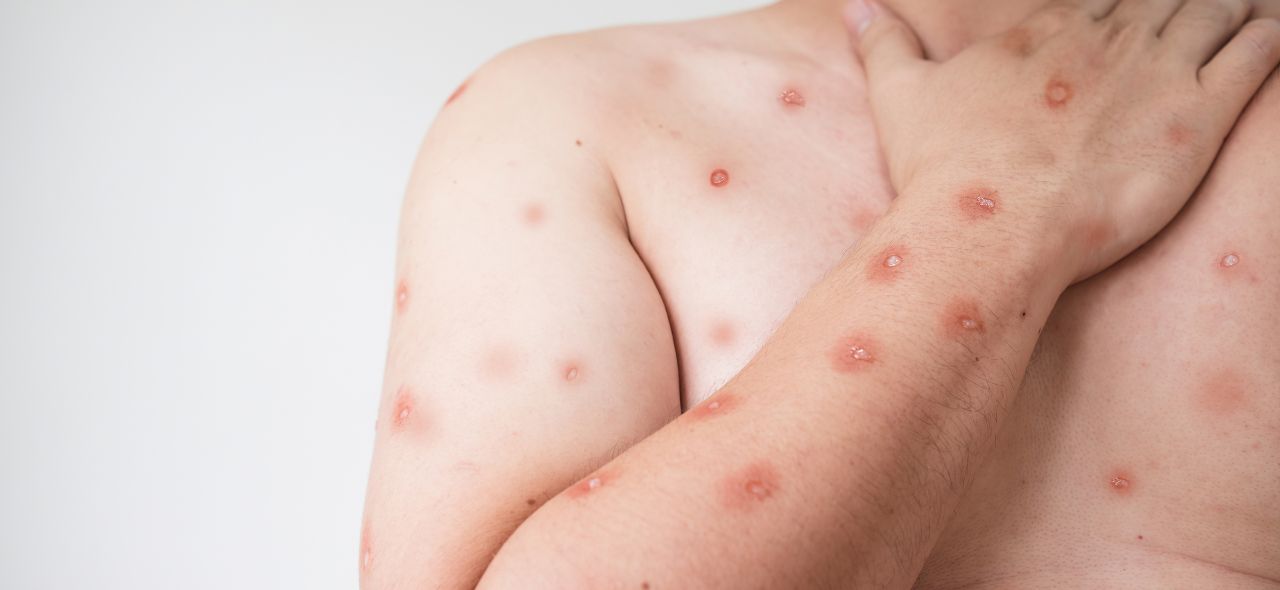 Brasil registra 90 casos de mpox