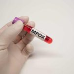 Casos de Mpox no Brasil chegam a 140 em 2026, diz Ministério