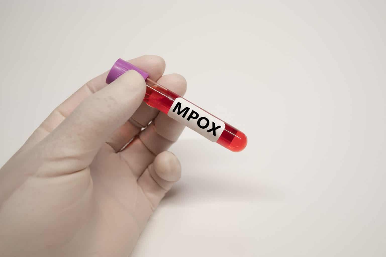 Casos de Mpox no Brasil chegam a 140 em 2026, diz Ministério