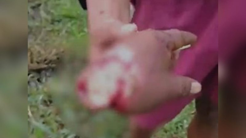 IMAGEM FORTE: Homem tem mão decepada a terçadadas durante briga por dinheiro em Manacapuru