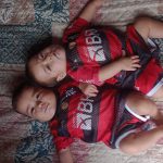 Gêmeas siamesas nascidas no AM completam 1 ano após cirurgia de separação bem-sucedida