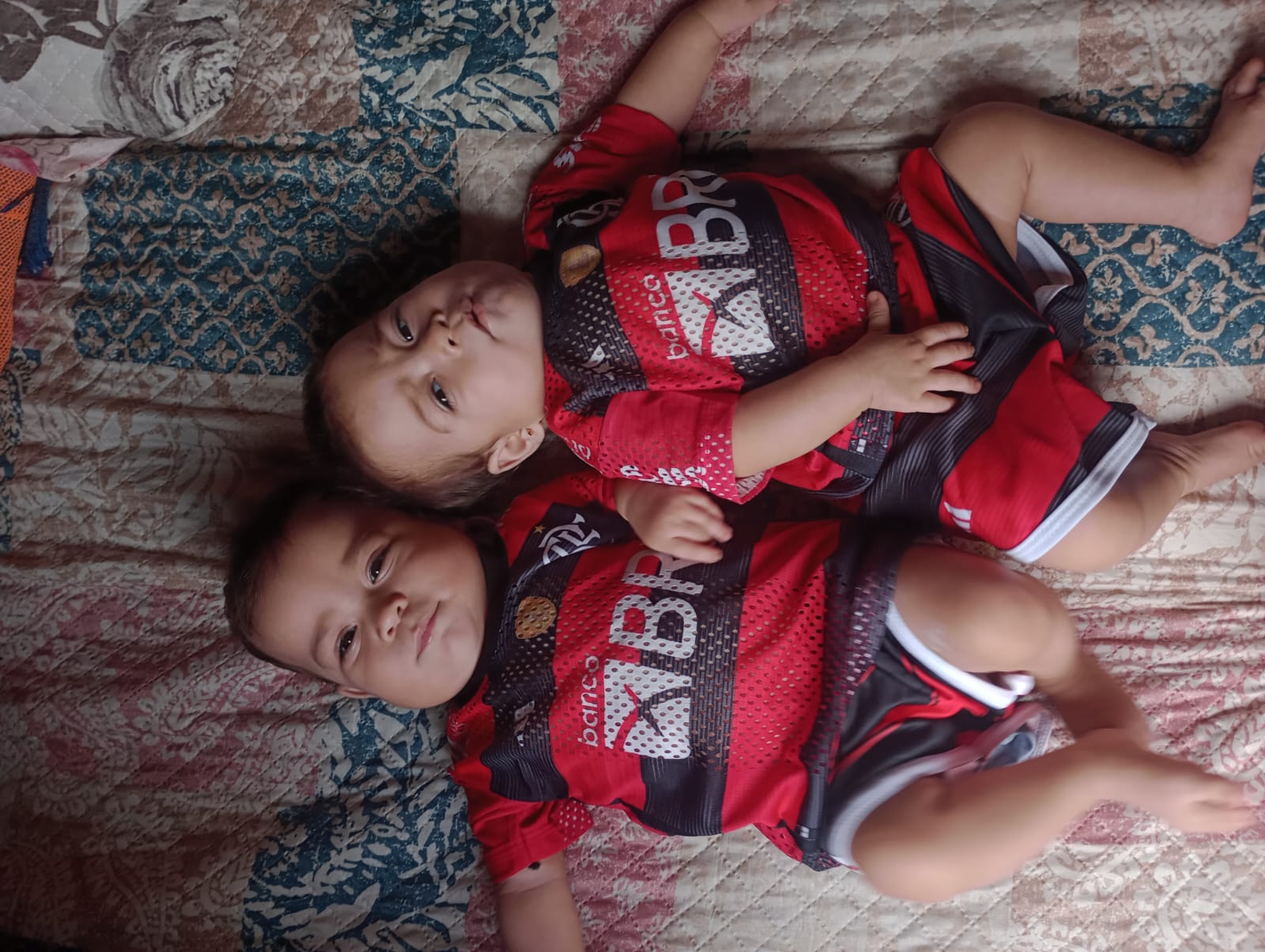 Gêmeas siamesas nascidas no AM completam 1 ano após cirurgia de separação bem-sucedida