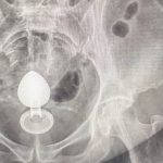 VÍDEO: Mulher é internada após plug anal ficar preso no intestino e médico faz alerta