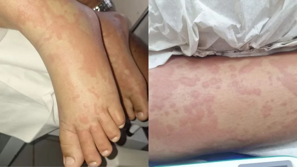 Criança está internada com diversas manchas pelo corpo