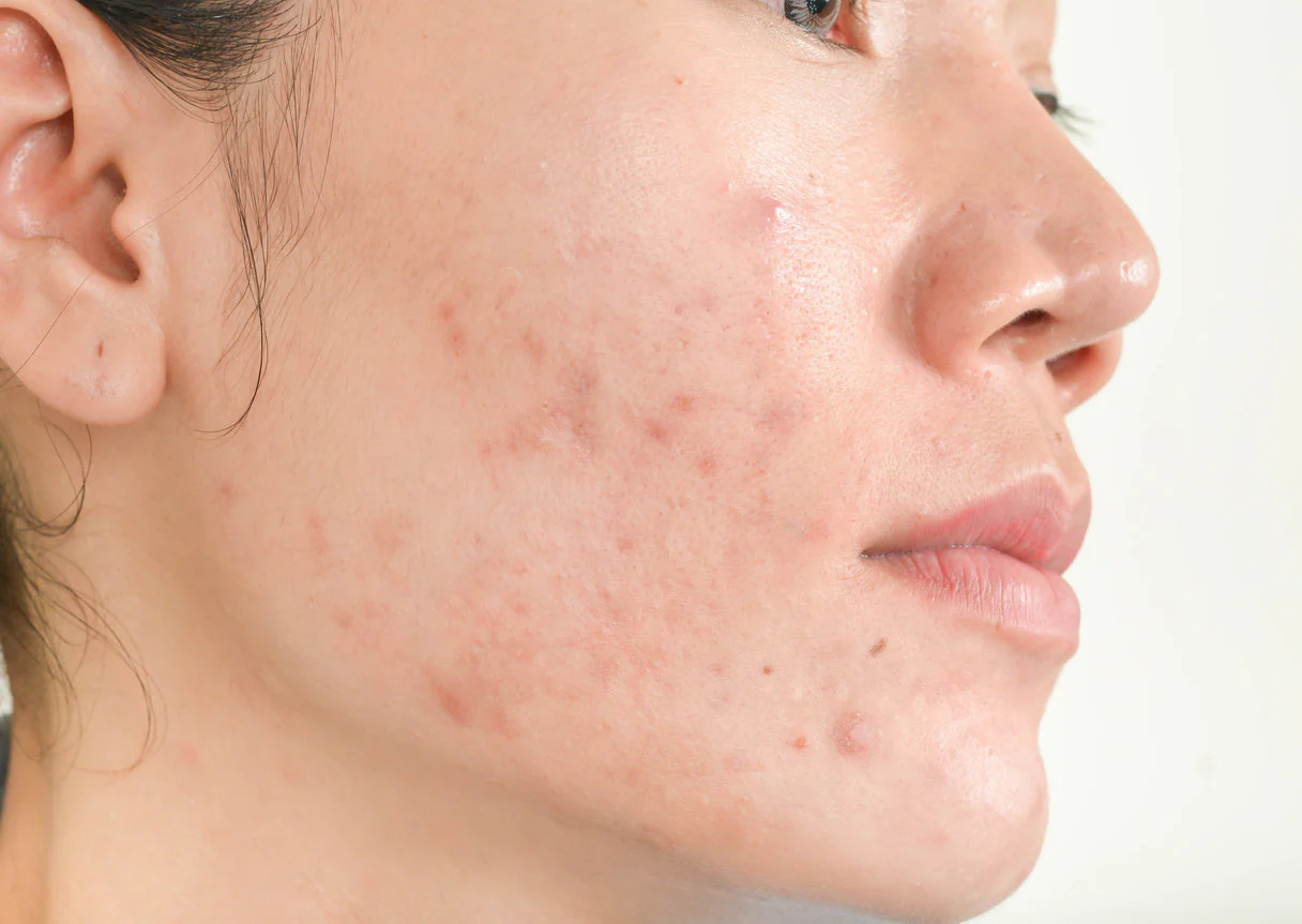 Acne: quando o problema não está no espelho… mas no intestino