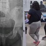 Mais de 200 agulhas no corpo ajudaram a desmascarar mulher que fingia ter 12 anos