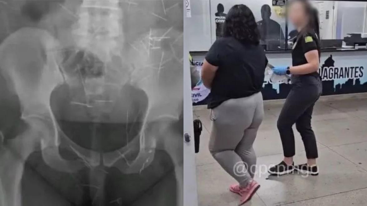 Mais de 200 agulhas no corpo ajudaram a desmascarar mulher que fingia ter 12 anos